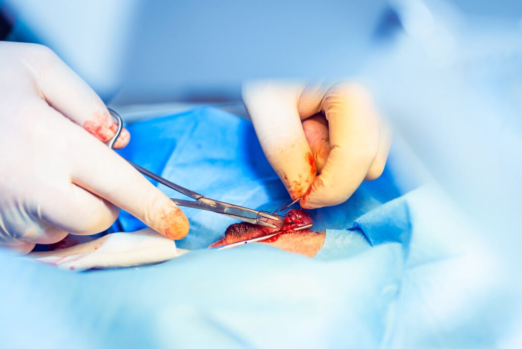 Sling Surgery